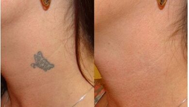 Why Choose Celibre for Tattoo Removal in Torrance